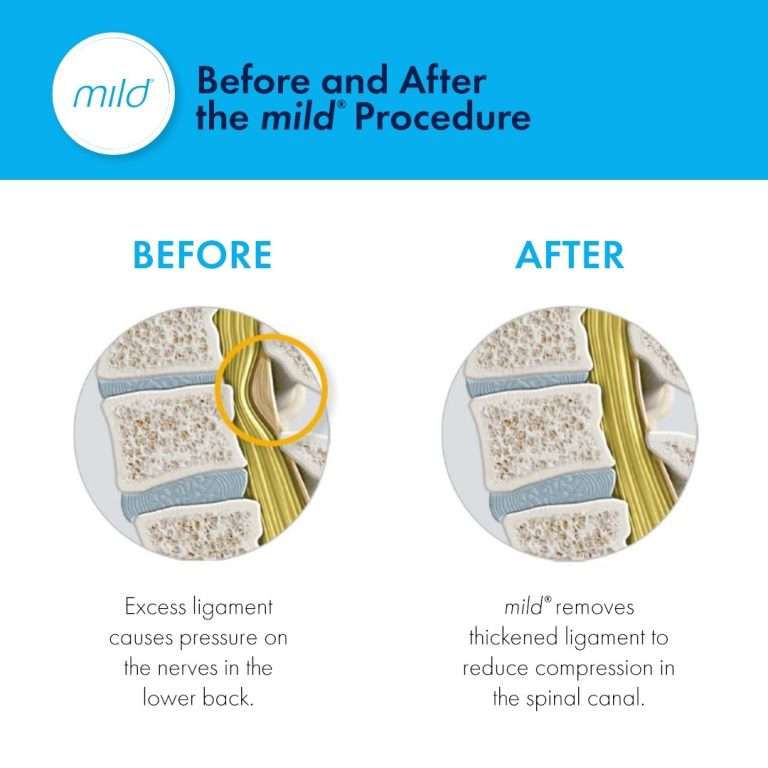 Is Lumbar Decompression Right for You?